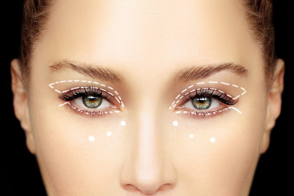 Planejamento de blefaroplastia com marcações nas pálpebras